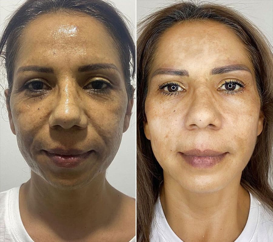 Antes / Después 1
