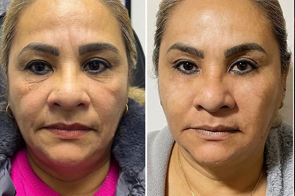 Antes / Después 2