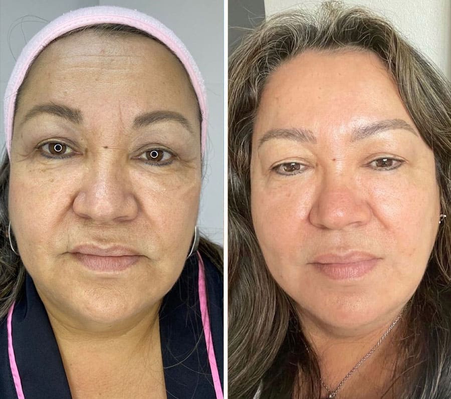 Antes / Después 3