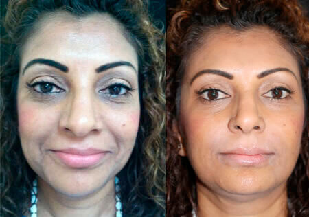 Antes / Después 4