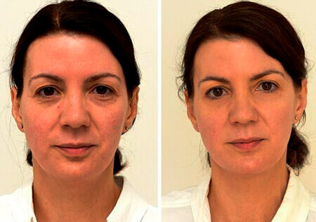 Antes / Después 5