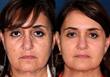 Antes / Después 6